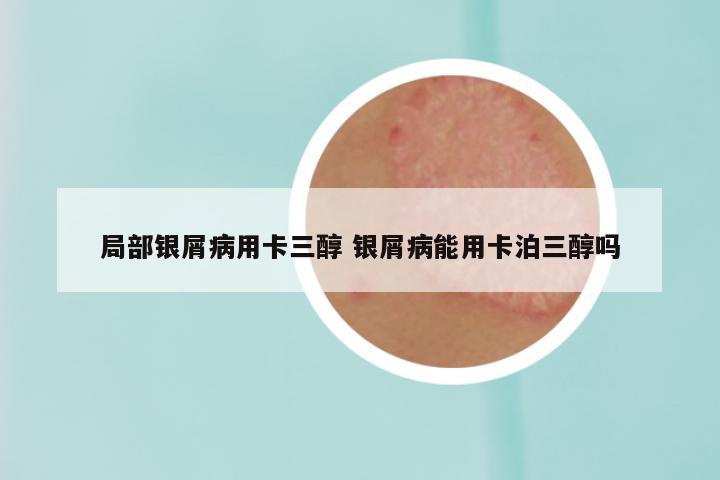 局部银屑病用卡三醇 银屑病能用卡泊三醇吗
