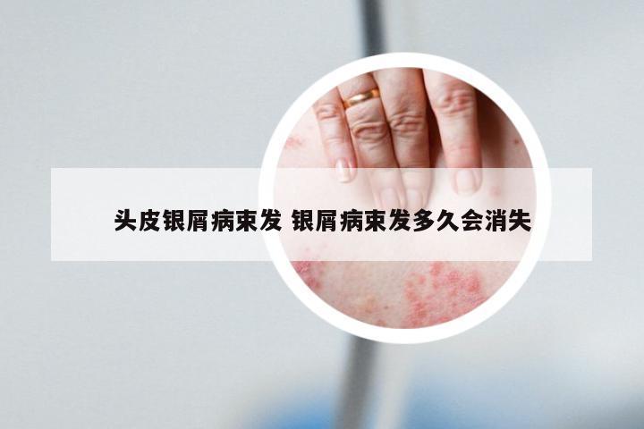 头皮银屑病束发 银屑病束发多久会消失