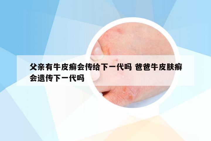 父亲有牛皮癣会传给下一代吗 爸爸牛皮肤癣会遗传下一代吗