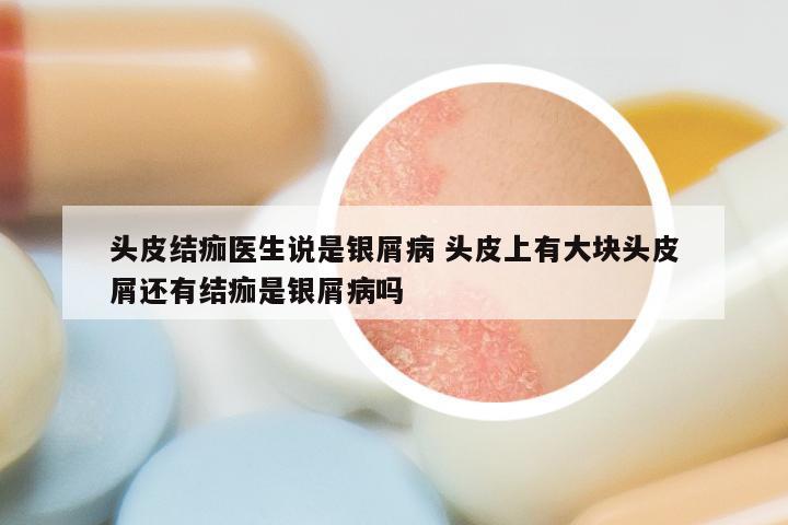 头皮结痂医生说是银屑病 头皮上有大块头皮屑还有结痂是银屑病吗