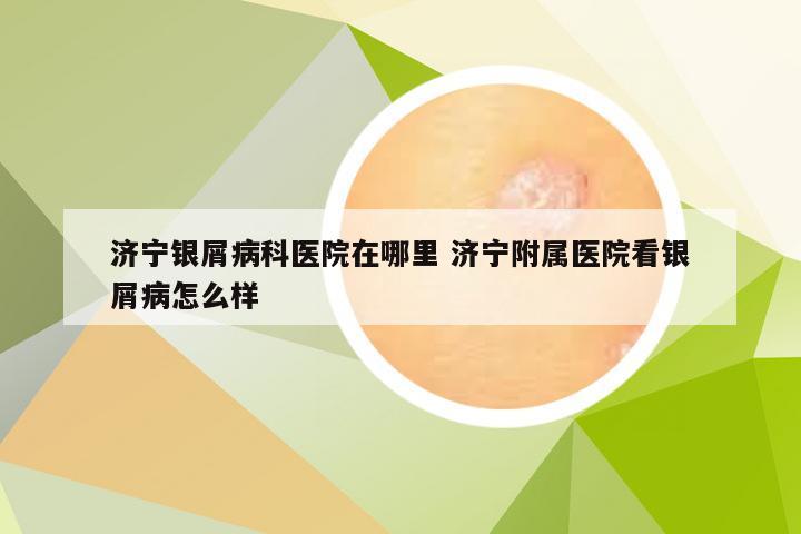 济宁银屑病科医院在哪里 济宁附属医院看银屑病怎么样