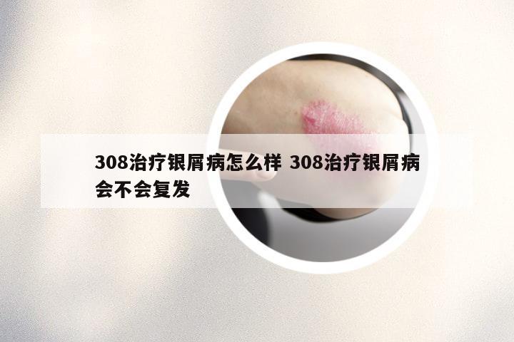 308治疗银屑病怎么样 308治疗银屑病会不会复发