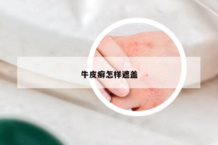 牛皮癣怎样遮盖