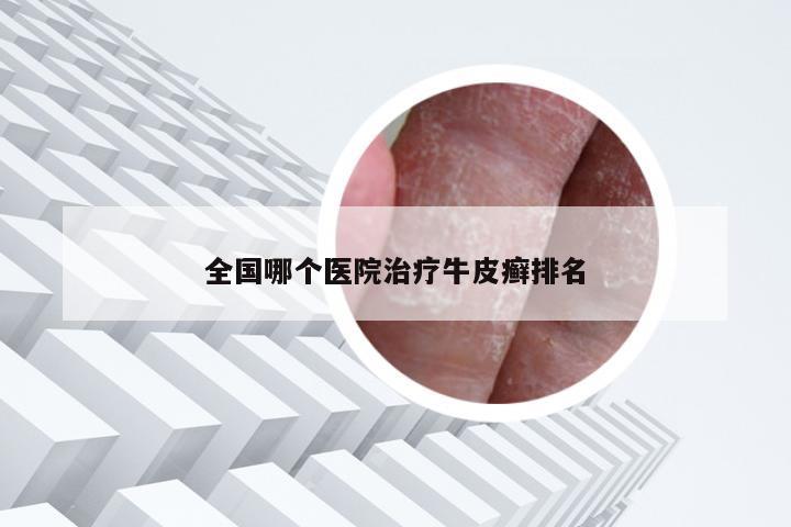 全国哪个医院治疗牛皮癣排名