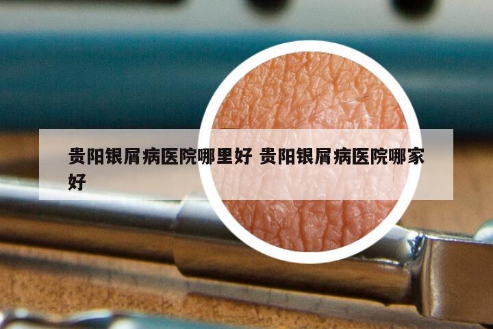 贵阳银屑病医院哪里好 贵阳银屑病医院哪家好
