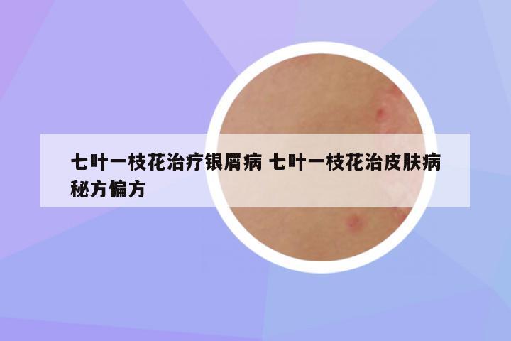 七叶一枝花治疗银屑病 七叶一枝花治皮肤病秘方偏方