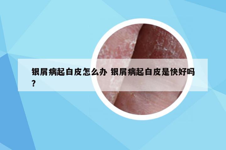 银屑病起白皮怎么办 银屑病起白皮是快好吗?