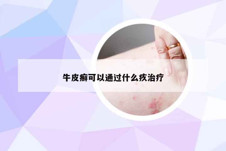 牛皮癣可以通过什么疚治疗