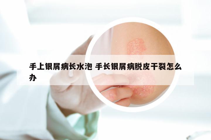 手上银屑病长水泡 手长银屑病脱皮干裂怎么办