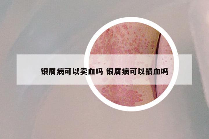 银屑病可以卖血吗 银屑病可以捐血吗