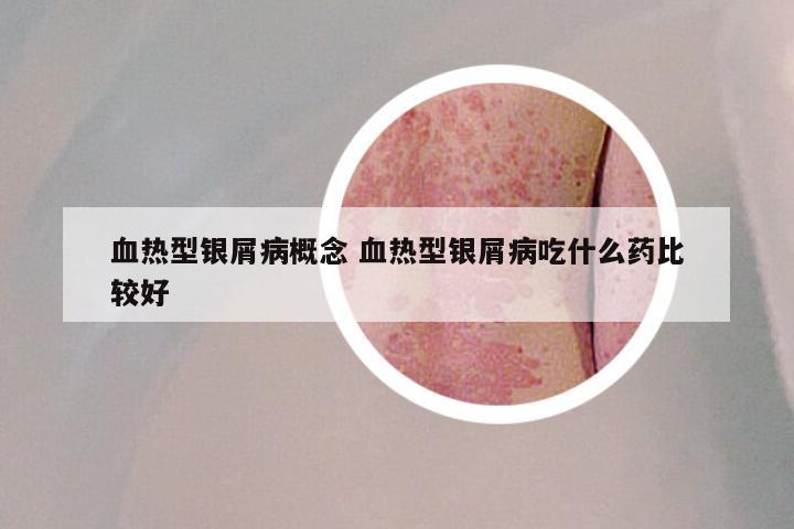 血热型银屑病概念 血热型银屑病吃什么药比较好