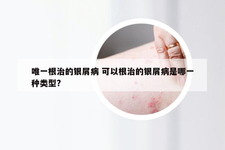 唯一根治的银屑病 可以根治的银屑病是哪一种类型?