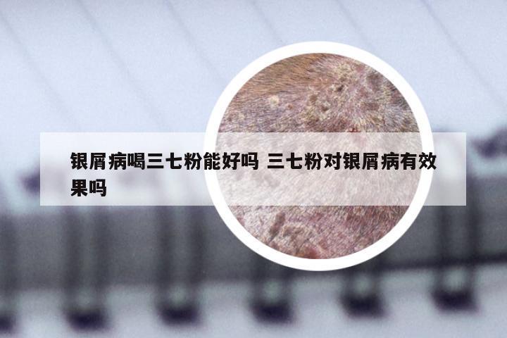 银屑病喝三七粉能好吗 三七粉对银屑病有效果吗