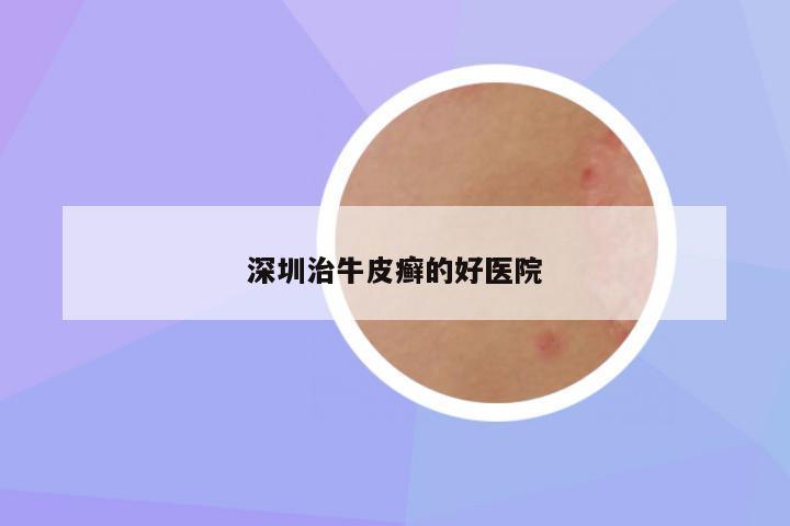 深圳治牛皮癣的好医院