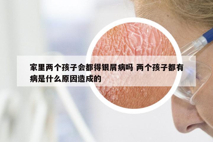 家里两个孩子会都得银屑病吗 两个孩子都有病是什么原因造成的