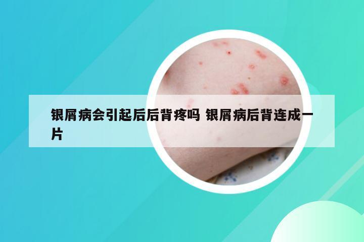 银屑病会引起后后背疼吗 银屑病后背连成一片