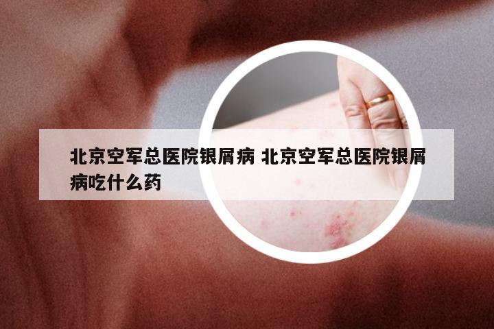 北京空军总医院银屑病 北京空军总医院银屑病吃什么药