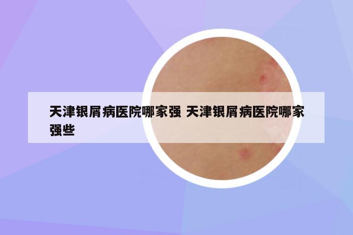 天津银屑病医院哪家强 天津银屑病医院哪家强些