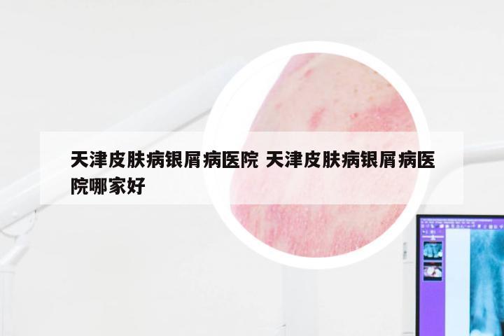 天津皮肤病银屑病医院 天津皮肤病银屑病医院哪家好