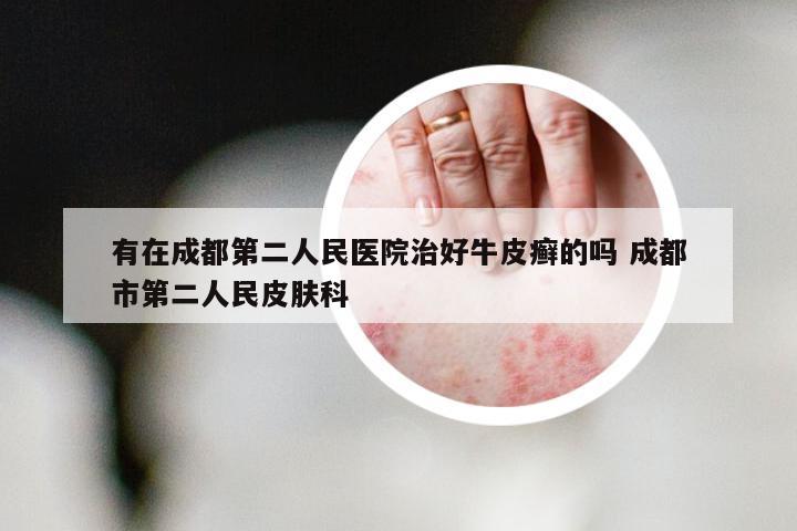 有在成都第二人民医院治好牛皮癣的吗 成都市第二人民皮肤科