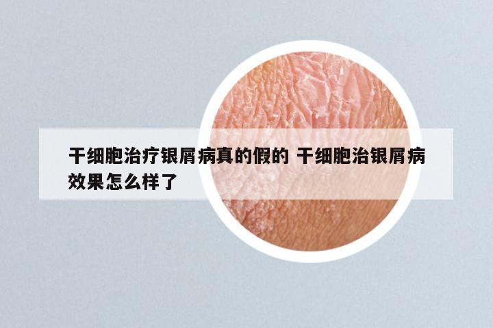 干细胞治疗银屑病真的假的 干细胞治银屑病效果怎么样了