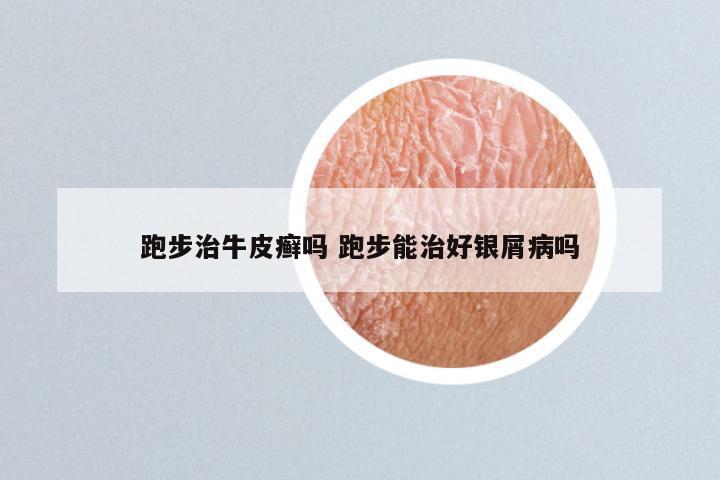 跑步治牛皮癣吗 跑步能治好银屑病吗