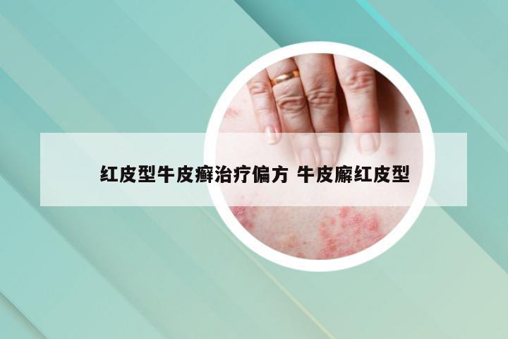红皮型牛皮癣治疗偏方 牛皮廨红皮型