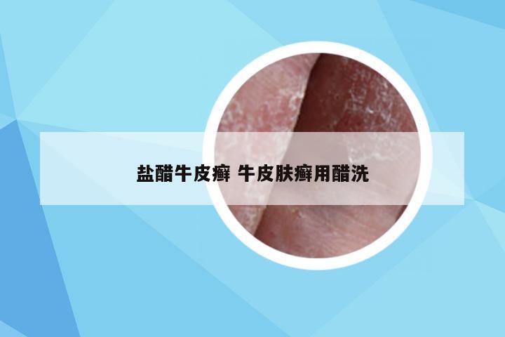 盐醋牛皮癣 牛皮肤癣用醋洗