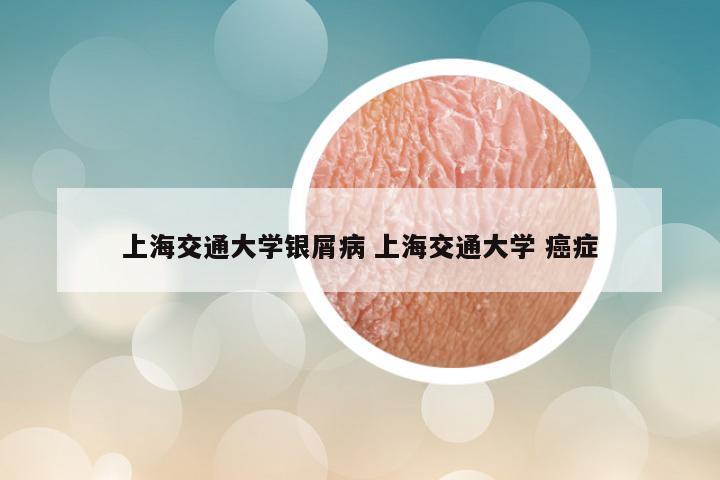 上海交通大学银屑病 上海交通大学 癌症