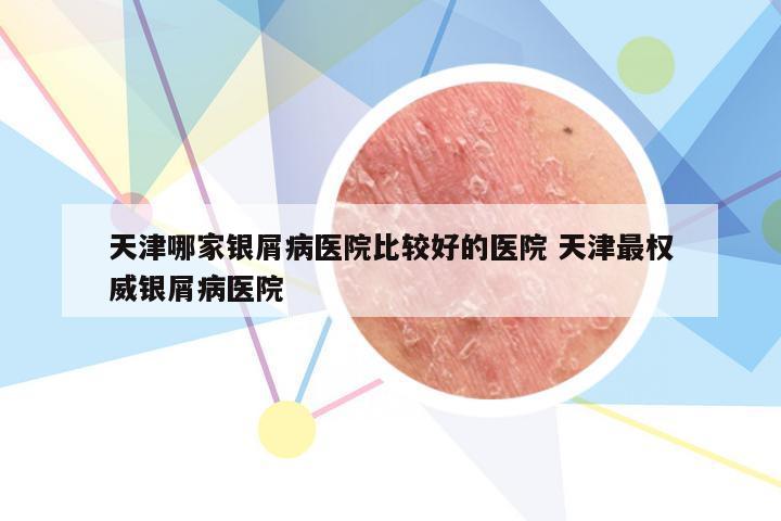 天津哪家银屑病医院比较好的医院 天津最权威银屑病医院