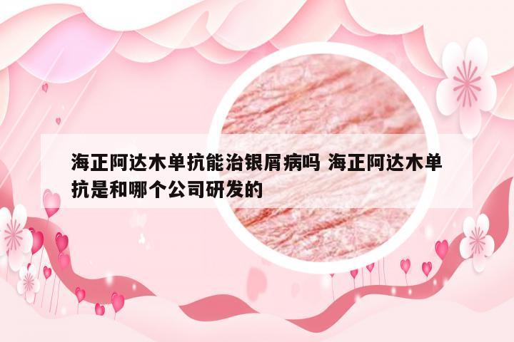 海正阿达木单抗能治银屑病吗 海正阿达木单抗是和哪个公司研发的