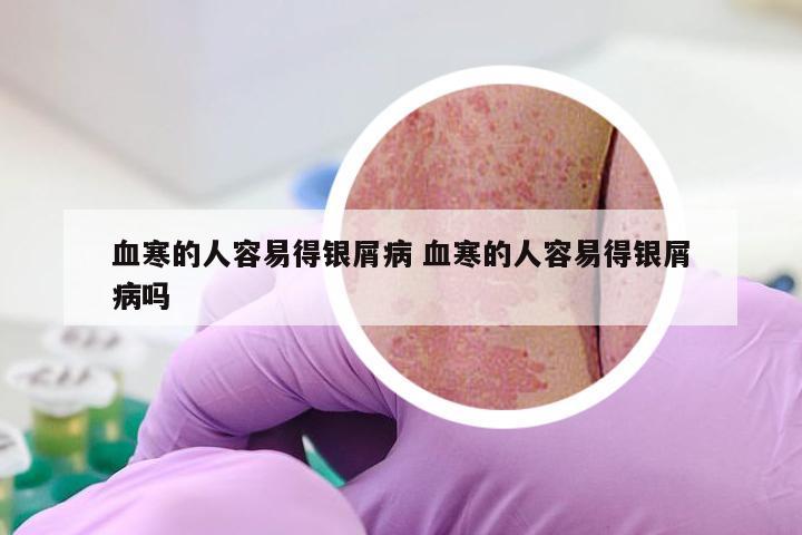 血寒的人容易得银屑病 血寒的人容易得银屑病吗