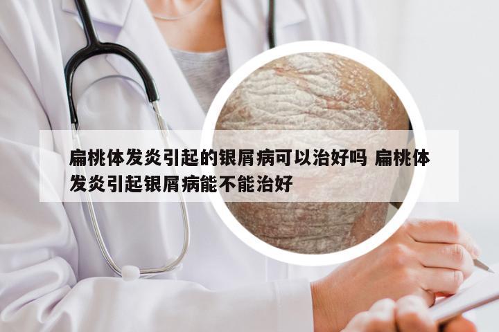扁桃体发炎引起的银屑病可以治好吗 扁桃体发炎引起银屑病能不能治好