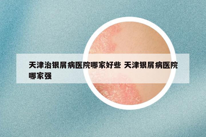 天津治银屑病医院哪家好些 天津银屑病医院哪家强