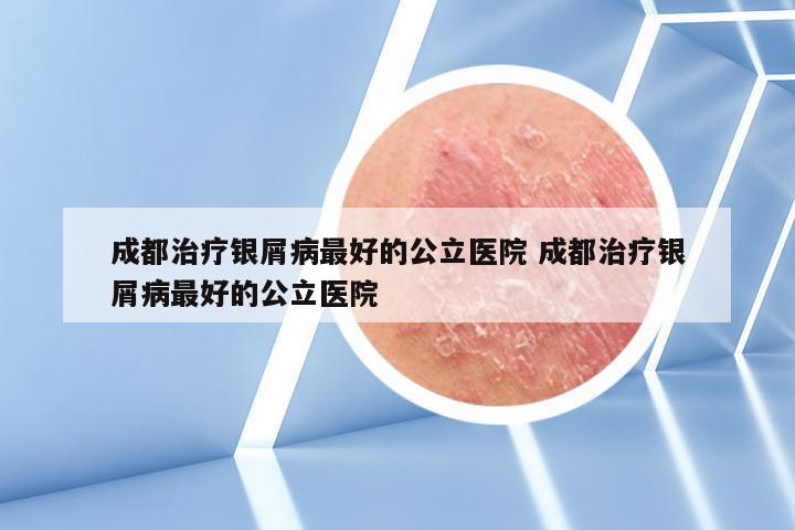 成都治疗银屑病最好的公立医院 成都治疗银屑病最好的公立医院