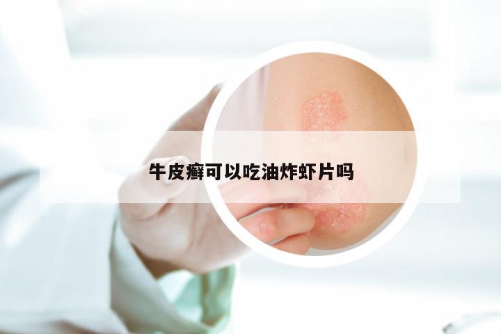 牛皮癣可以吃油炸虾片吗