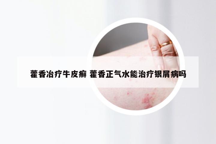 藿香冶疗牛皮癣 藿香正气水能治疗银屑病吗