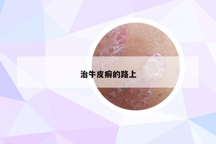 治牛皮癣的路上
