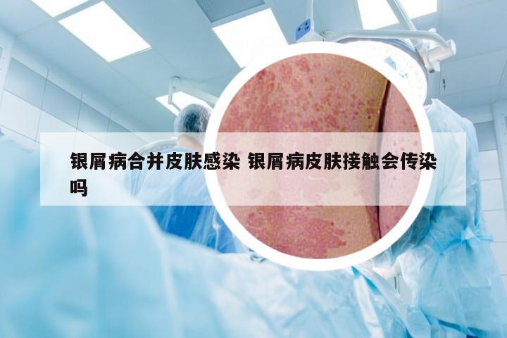 银屑病合并皮肤感染 银屑病皮肤接触会传染吗
