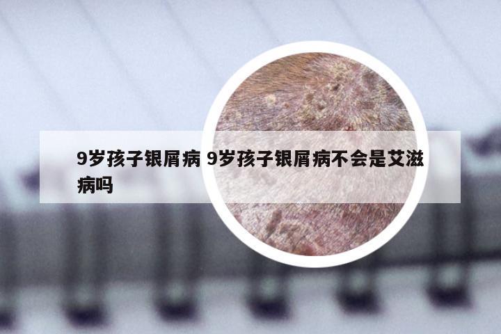 9岁孩子银屑病 9岁孩子银屑病不会是艾滋病吗