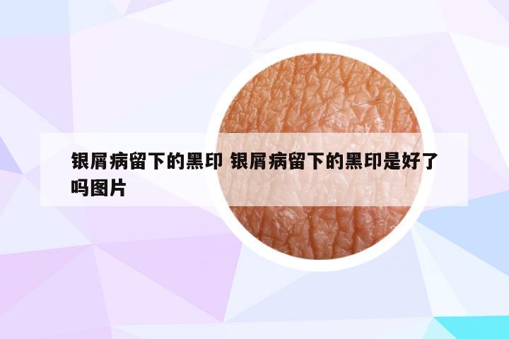 银屑病留下的黑印 银屑病留下的黑印是好了吗图片