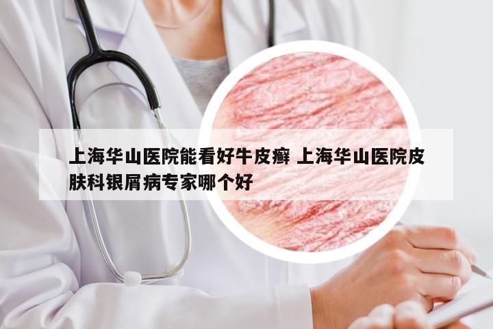 上海华山医院能看好牛皮癣 上海华山医院皮肤科银屑病专家哪个好