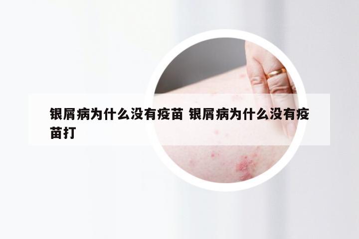 银屑病为什么没有疫苗 银屑病为什么没有疫苗打
