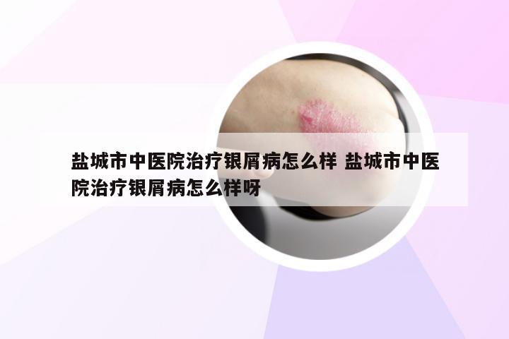 盐城市中医院治疗银屑病怎么样 盐城市中医院治疗银屑病怎么样呀