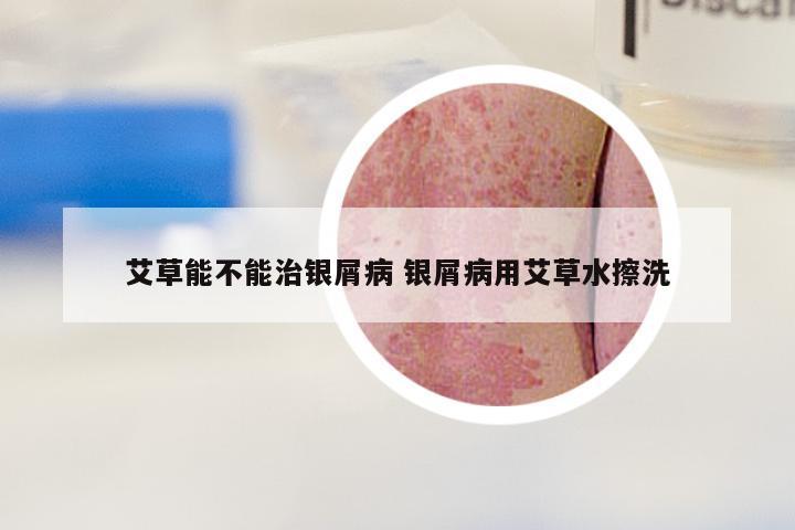 艾草能不能治银屑病 银屑病用艾草水擦洗