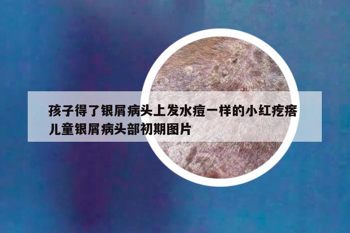 孩子得了银屑病头上发水痘一样的小红疙瘩 儿童银屑病头部初期图片