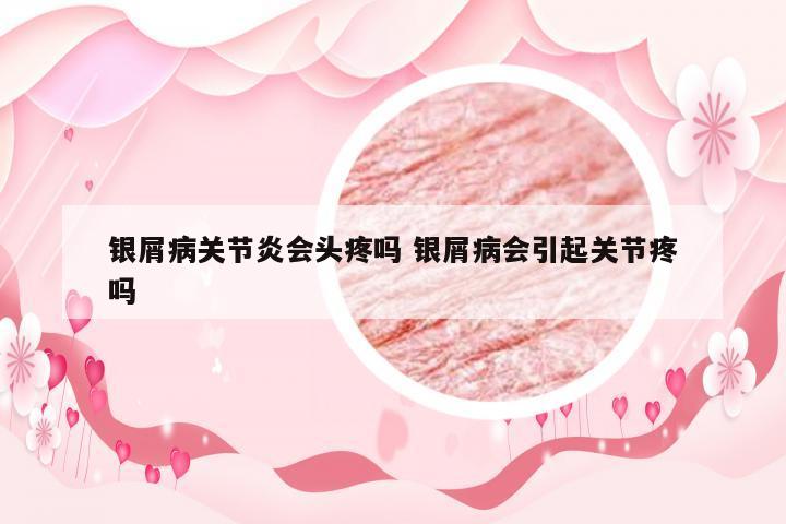 银屑病关节炎会头疼吗 银屑病会引起关节疼吗