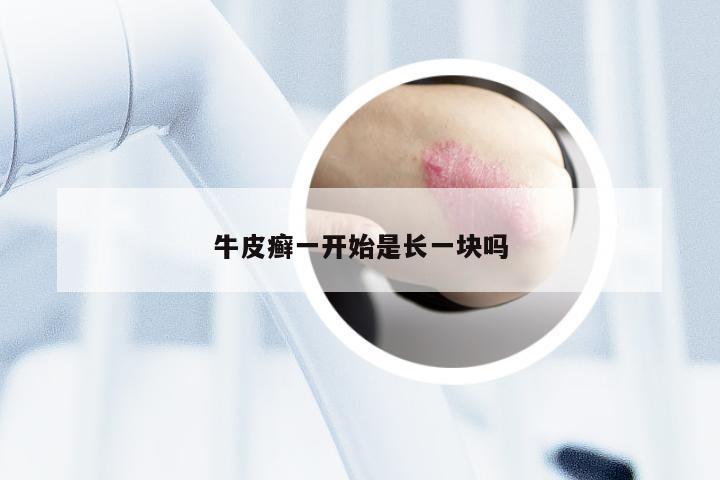 牛皮癣一开始是长一块吗