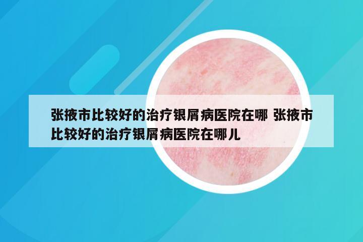 张掖市比较好的治疗银屑病医院在哪 张掖市比较好的治疗银屑病医院在哪儿