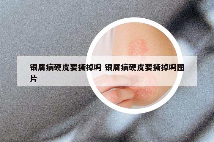 银屑病硬皮要撕掉吗 银屑病硬皮要撕掉吗图片